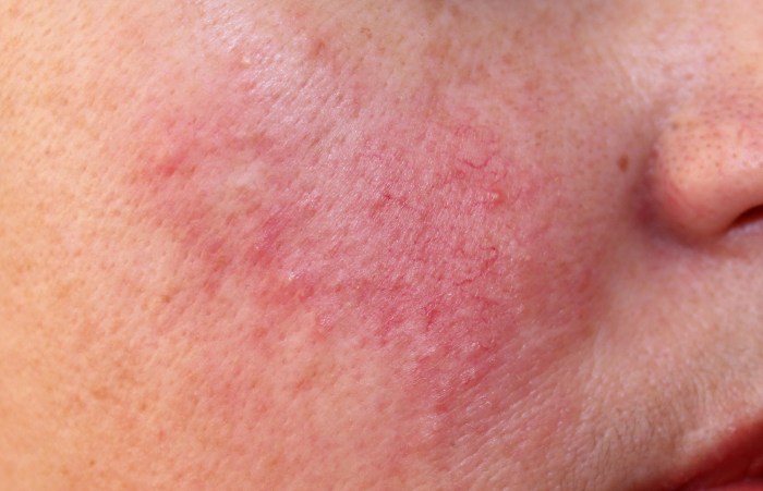 Couperose skin is indicated by